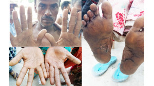 আর্সেনিক আক্রান্ত বালিয়াডাঙ্গা ইউনিয়নের বেতবাড়িয়া গ্রামের  অধিকাংশ মানুষ 