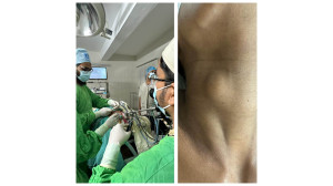 ম্যাক্স হসপিটালে  দাগহীন থাইরয়েড সার্জারি করলেন ডা. মাহবুব