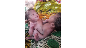 চাঁপাইনবাবগঞ্জে শরীর জোড়া লাগানো যমজ সন্তানের জন্ম - বিপাকে গরীব পরিবার 