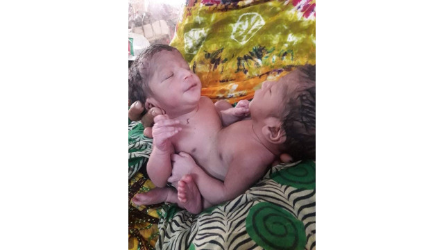চাঁপাইনবাবগঞ্জে শরীর জোড়া লাগানো যমজ সন্তানের জন্ম - বিপাকে গরীব পরিবার