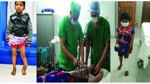 চাঁপাইনবাবগঞ্জে সুখীমনের ৭ বছরের বাঁকা পা সোজা করলেন ডা. ইসমাইল